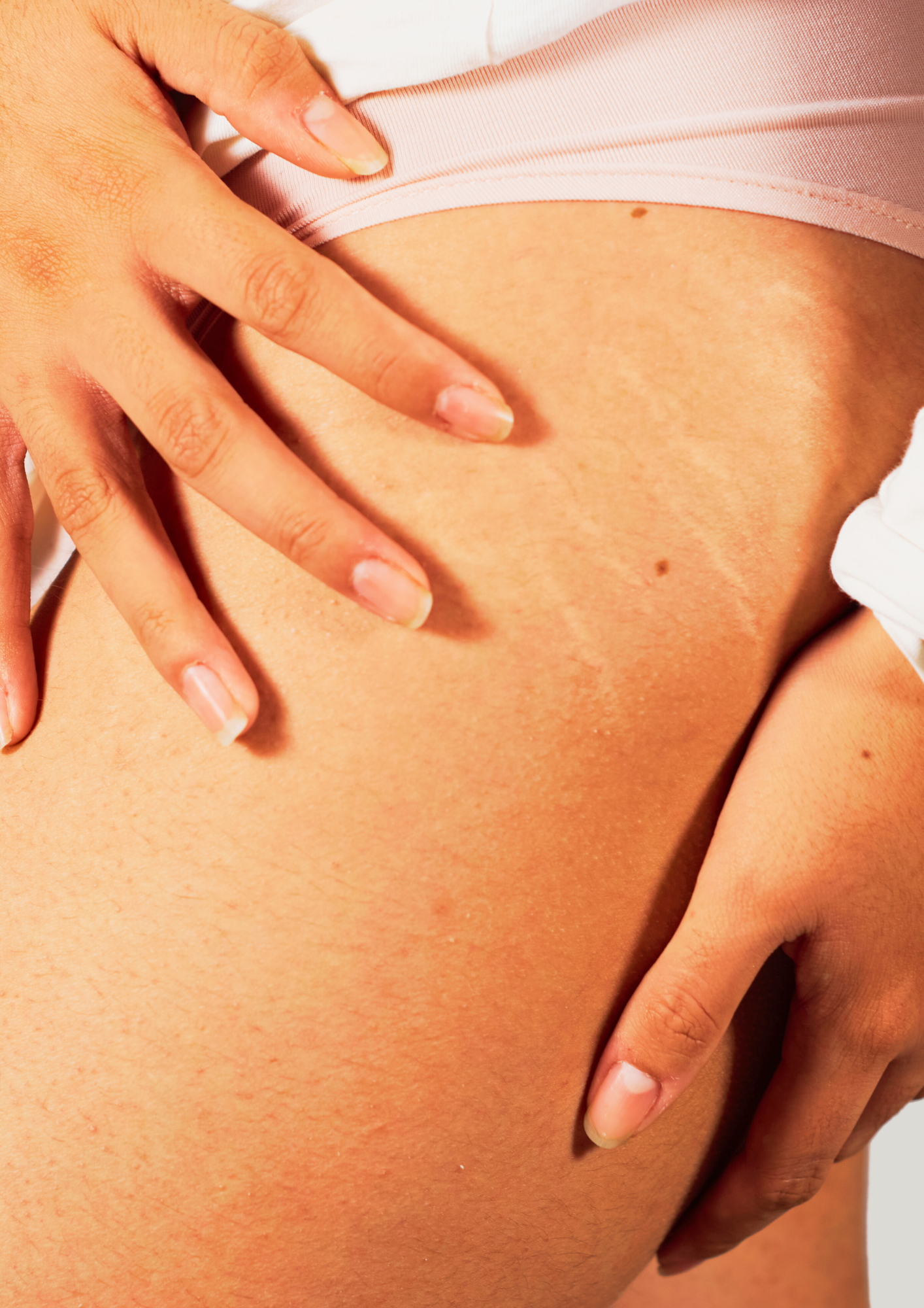 vergetures sur la jambe d'une femme